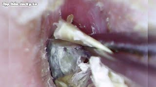 Ear Wax Removal 110 Itching All Day Because Of Dry And Thick Earwax  Ear Cleaning ASMR [upl. by Nedyarb443]