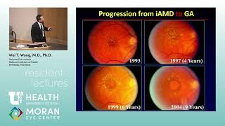 Geographic Atrophy in AMD Clinical Features and Interventional Trials [upl. by Aisek]