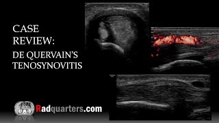 Ultrasound of de Quervain’s Tenosynovitis [upl. by Carolan]