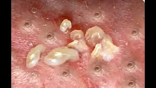 Shocking Cystic Blackheads amp Whiteheads Extraction Revealed  new blackheads this week 12301 [upl. by Somerville]