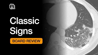 Classic Signs  Chest Radiology Board Review [upl. by Reinar909]