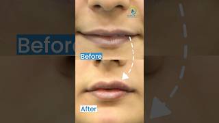 Lip Filler Before After Result  Before After of Lip Fillers [upl. by Anas878]