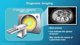 Pancreatic Cancer Pathophysiology Diagnosis and Staging [upl. by Ynnahc]