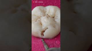 Clean Tooth or Cavity Tooth Must Watch toothrestoration dentist [upl. by Ahsiekal]