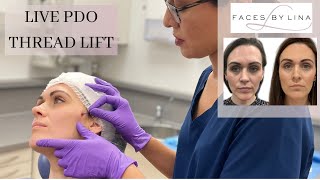 Watch the PDO Thread Lift in Action Say Goodbye to Nasolabial Folds and Marionette Lines [upl. by Zetrauq]