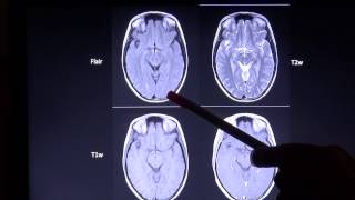 Grundlagen und Unterscheidungsmerkmale zu wichtigen MRT Sequenzen [upl. by Reivax]
