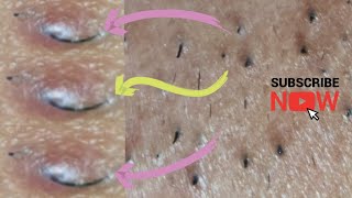 Ingrown hair  thick facial hair extraction [upl. by Ateiluj]