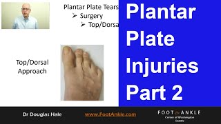 Plantar Plate Injuries  Part 2  Seattle Podiatrist [upl. by Dewain]