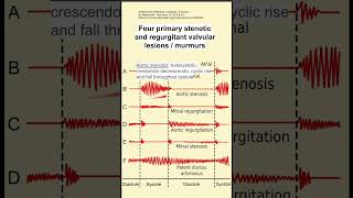 Four primary stenotic and regurgitant valvular lesions  murmurs [upl. by Savdeep]