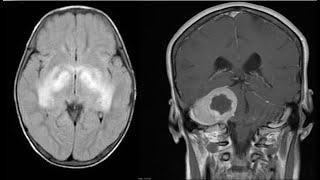 15CNSneuroradiologySpotterscasesradiopediaMRICTXrayangiographyquizzesfrcrexamsbesttip [upl. by Gimble]