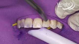 Opalustre by Ultradent with Dr H Seedat [upl. by Feenah571]