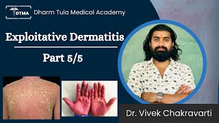 Dermatitis  Exfoliative Dermatitis Hindi  Types  Part 55 Eczema  Skin Disease  Skin Infection [upl. by Osmond454]