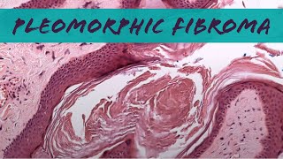 Pleomorphic fibroma looks like skin tag but relative of spindle cellpleomorphic lipoma pathology [upl. by Krik733]