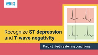 Simplifying ST depression and Twave negativity [upl. by Tegan696]