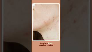 Accutane amp Skincare Essential Tips for Treating Acne [upl. by Schoening]