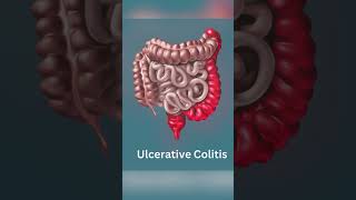 Understanding Crohns Disease vs Ulcerative Colitis [upl. by Nagar686]