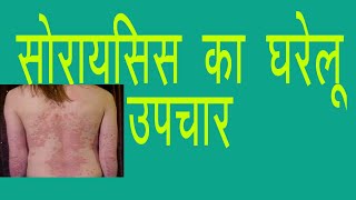 स्कैल्प सोरायसिस के लिए घरेलू उपचार  scalp psoriasis home remedies factsandmeinhindi [upl. by Drofhsa]