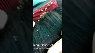 Combing a Diseased Itchy Dry Scalp shorts dandruff irritated scalp [upl. by Alderman]