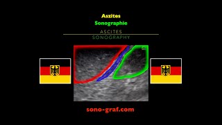 Sonographie Aszites [upl. by Thecla]