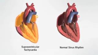 supraventricular tachycardia [upl. by Paver]