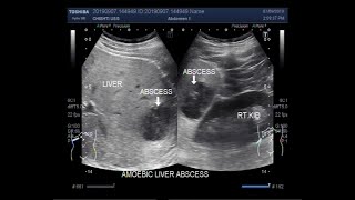 Ultrasound video showing Amoebic hepatic abscess [upl. by Schonfeld643]