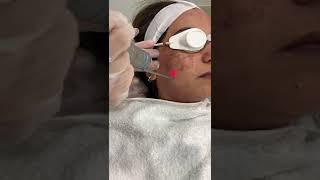 QSwitched Laser Toning pigmentation removal [upl. by Elagiba]