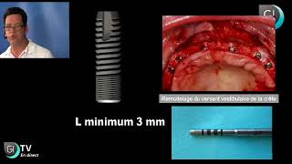 Implants Dentaires  Lexpansion osseuse [upl. by Arissa]