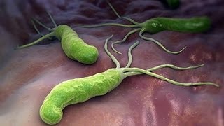 HELICOBACTER PYLORI Ulcera Peptica Ulcera Gastrica Tratamiento [upl. by Corri587]