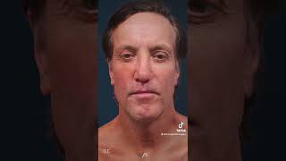 TRACELESS FACE amp NECK LIFT Before and After  Proof You NEED It [upl. by Adnuhsat709]