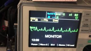 Sick Sinus Syndrome [upl. by Ielhsa]