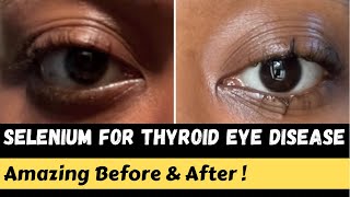 My Experience with Selenium for Thyroid Eye Disease [upl. by Naasah994]