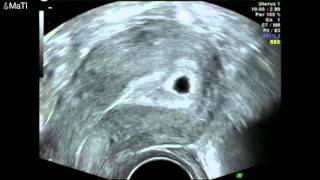 Early pregnancy scan  ultrasound 5 weeks gestation [upl. by Alledi]