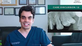 Case Discussion 12  Saving a tooth with PostCore [upl. by Wylma]