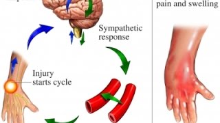 Complex Regional Pain Syndrome CRPS [upl. by Ecyned]