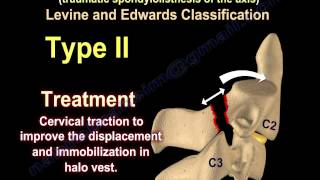 Hangmans Fracture  Everything You Need To Know  Dr Nabil Ebraheim [upl. by Loris]