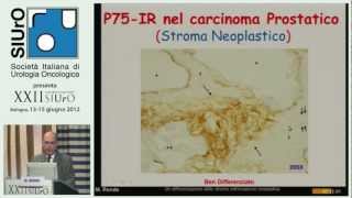 Dedifferenziazione dello stroma nellinvasione neoplastica [upl. by Annis]