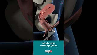 Dilation And Curettage DampC  Fertility Treatment ↪3D Medical Animation Shorts DilationampCurettage [upl. by Pence]