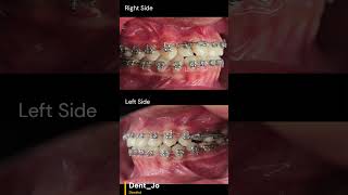 Journey braches in cases of anterior crossbite behel behelgigi braches dentalbraces [upl. by Buote326]