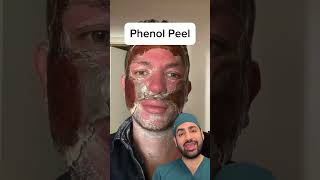 Phenol Peel skincare [upl. by Enyrb]