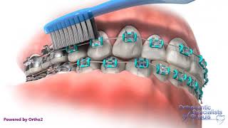 Proper Brushing  Orthodontic Care Instructions [upl. by Saduj981]