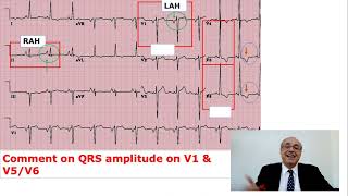 EKG Trainer Case 5 Answer [upl. by Nowyt488]