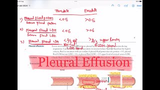 Pleural Effusion  Transudate Vs Exudate Respiratory 47  First Aid USMLE Step 1 in UrduHindi [upl. by Ker]