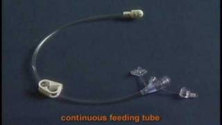 MICKEY Feeding Tube Kit Contents [upl. by Heuser]