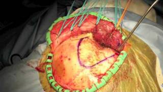 Neurosurgery  Pterional Craniotomy [upl. by Airotciv539]