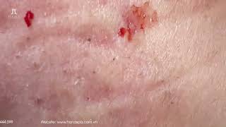 Big Cystic Acne Blackheads Extraction Blackheads amp Milia Whiteheads Removal Pimple Popping [upl. by Elda]