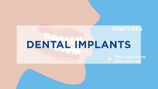 Dental Implants vs Bridges 15 [upl. by Aremihc331]