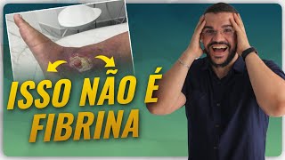 ISSO AQUI NÃO É FIBRINA ENTENDA Fibrina ou Esfacelo [upl. by Allecnirp]