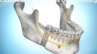 Mandibular Advancement BSSO [upl. by Florie]