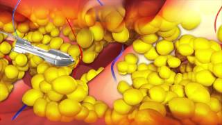 Animation Waterjet Assisted Liposuction  wasserstrahlassistierte Liposuktion WAL [upl. by Dorcus]