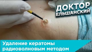 Удаление кератомы радиоволновым методом [upl. by Nailuj]